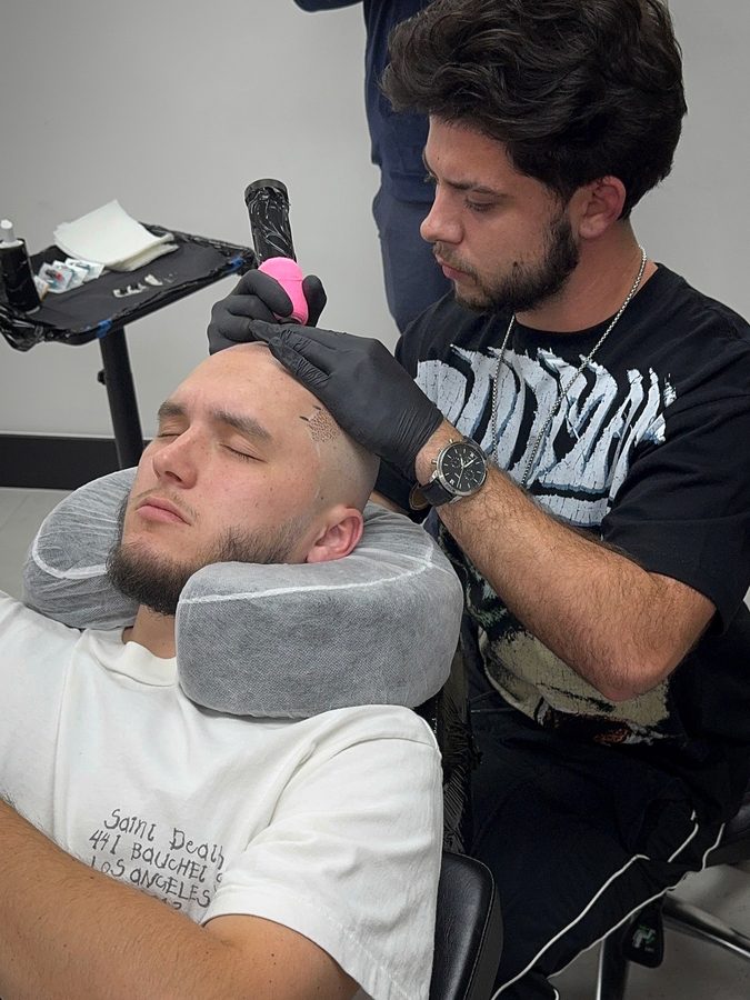 Client before scalp micropigmentation — thinning crown