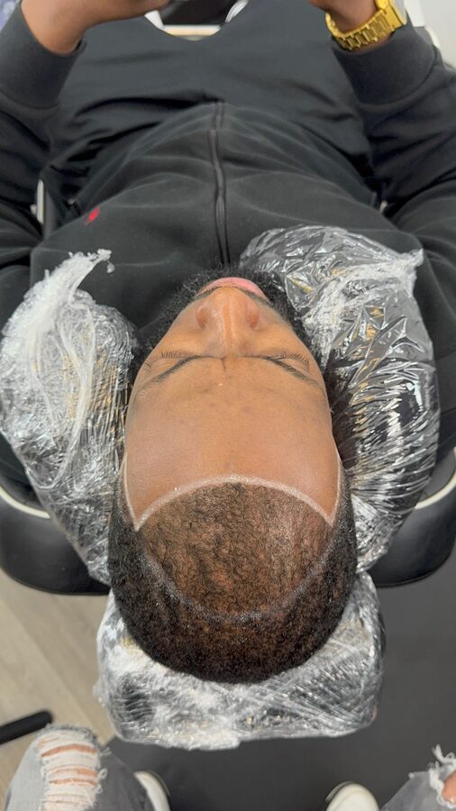 Scalp micropigmentation healing in the first week — fresh pigment settling