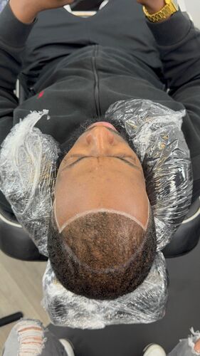Scalp micropigmentation session in progress — BLNDD, Metairie