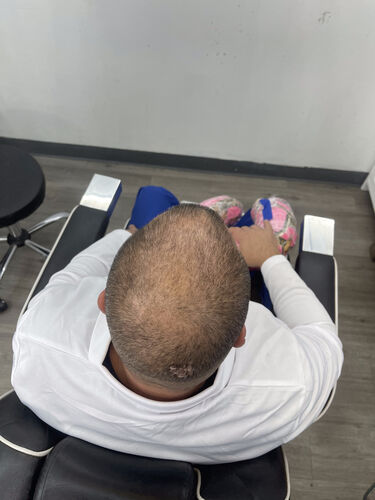 Scalp micropigmentation session in progress — BLNDD, Metairie
