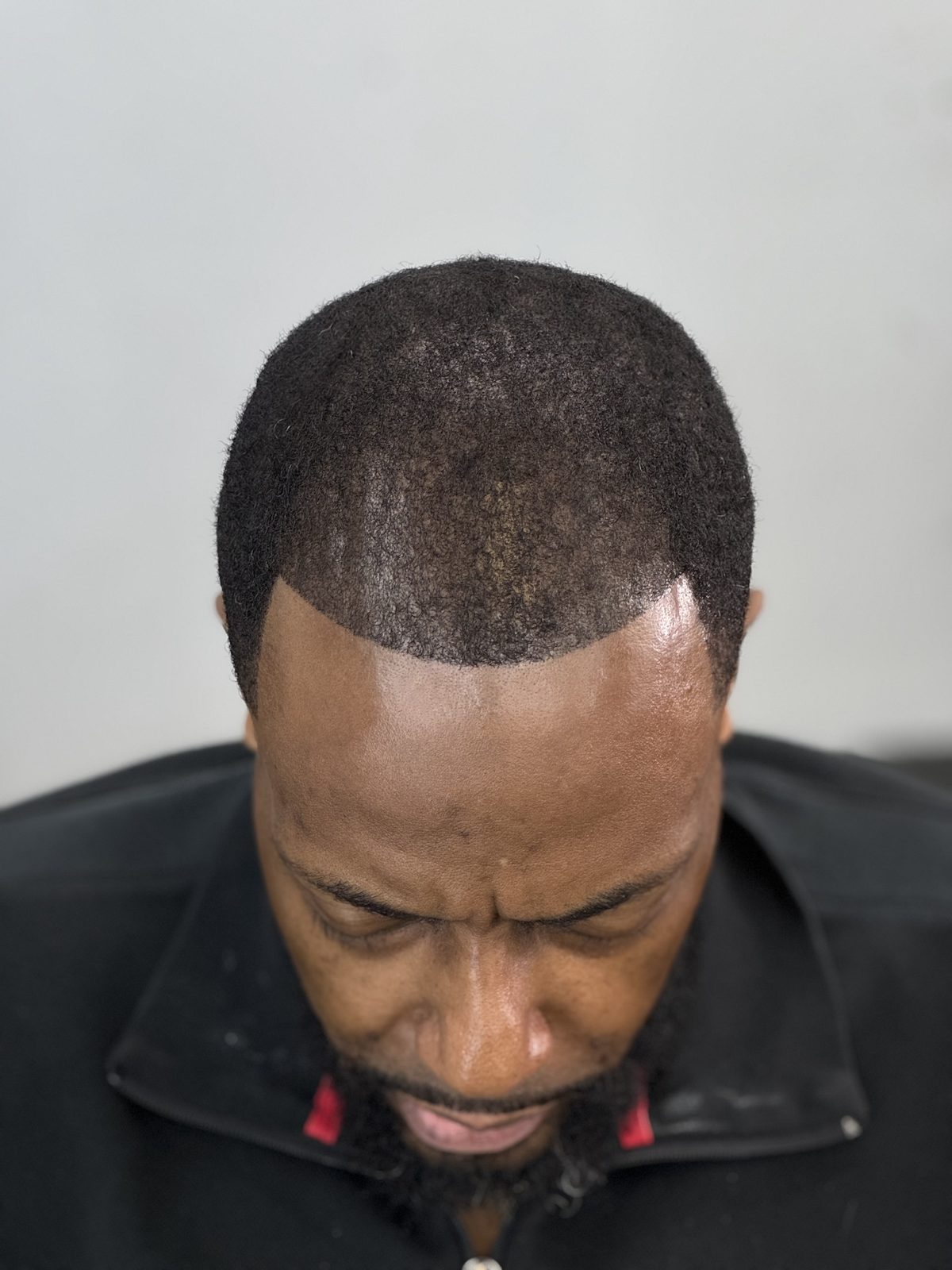 Scalp micropigmentation result — a natural, close-shaved look