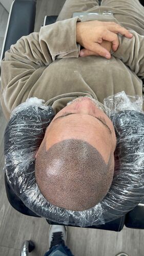 Scalp micropigmentation session in progress — BLNDD, Metairie