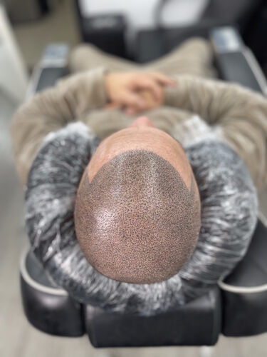 Scalp micropigmentation session in progress — BLNDD, Metairie