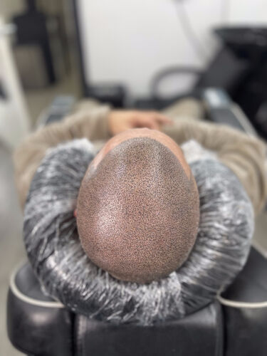 Scalp micropigmentation session in progress — BLNDD, Metairie