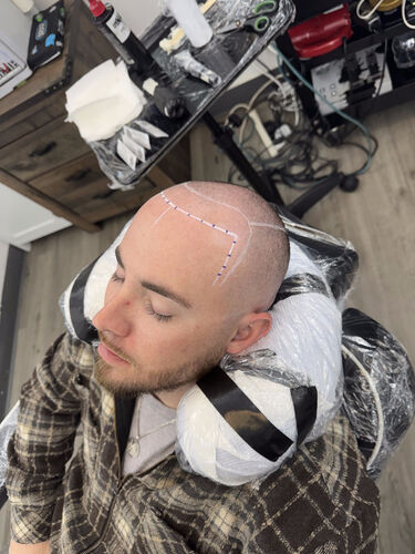 Hairline mapped and marked before SMP
