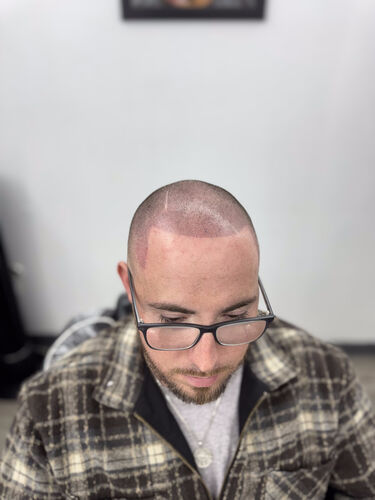 Scalp micropigmentation session in progress — BLNDD, Metairie