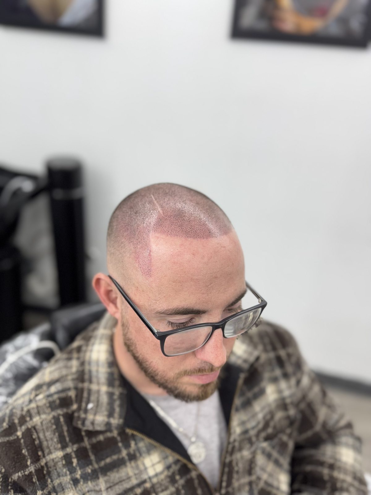 Scalp micropigmentation session in progress