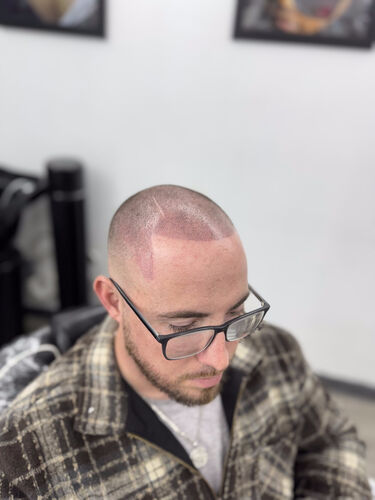 Scalp micropigmentation session in progress — BLNDD, Metairie