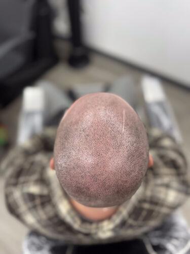 Scalp micropigmentation session in progress — BLNDD, Metairie
