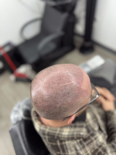 Scalp micropigmentation session in progress — BLNDD, Metairie