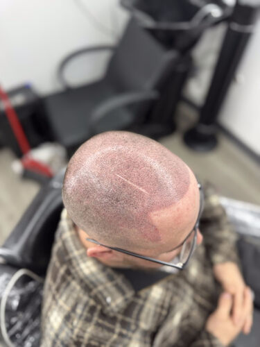 Scalp micropigmentation session in progress — BLNDD, Metairie