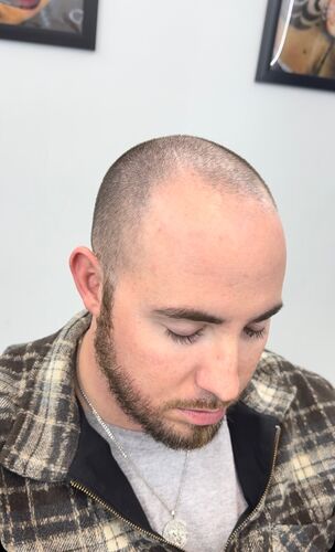 SMP result — front hairline
