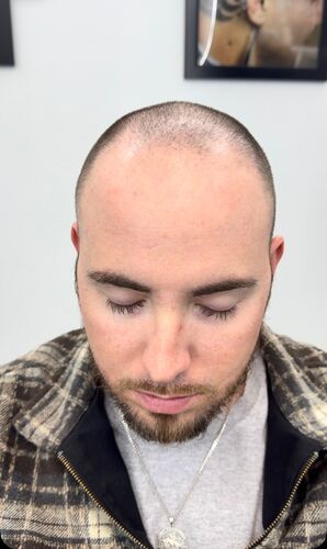 Scalp micropigmentation result by Shaun Fade — Metairie, LA