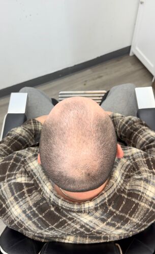 Scalp micropigmentation result by Shaun Fade — Metairie, LA