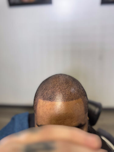 Scalp micropigmentation result by Shaun Fade — Metairie, LA