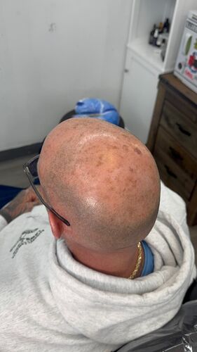 Scalp micropigmentation result by Shaun Fade — Metairie, LA