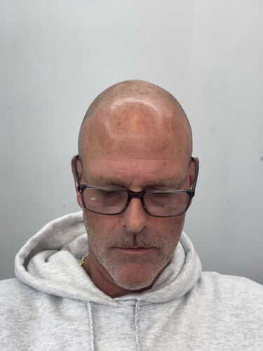 Scalp micropigmentation result by Shaun Fade — Metairie, LA