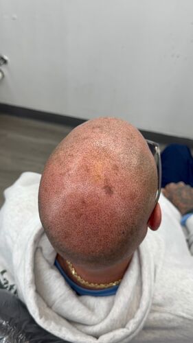 Scalp micropigmentation result by Shaun Fade — Metairie, LA
