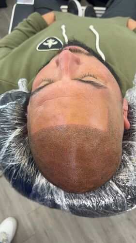 Scalp micropigmentation session in progress — BLNDD, Metairie