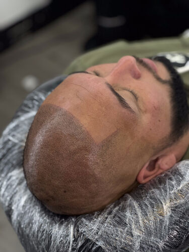 Scalp micropigmentation session in progress — BLNDD, Metairie