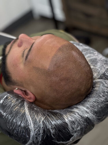 Scalp micropigmentation session in progress — BLNDD, Metairie