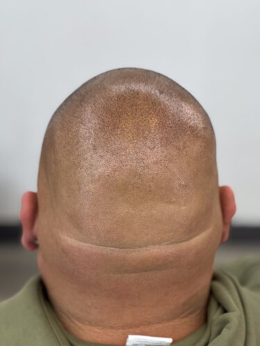 Scalp micropigmentation result by Shaun Fade — Metairie, LA
