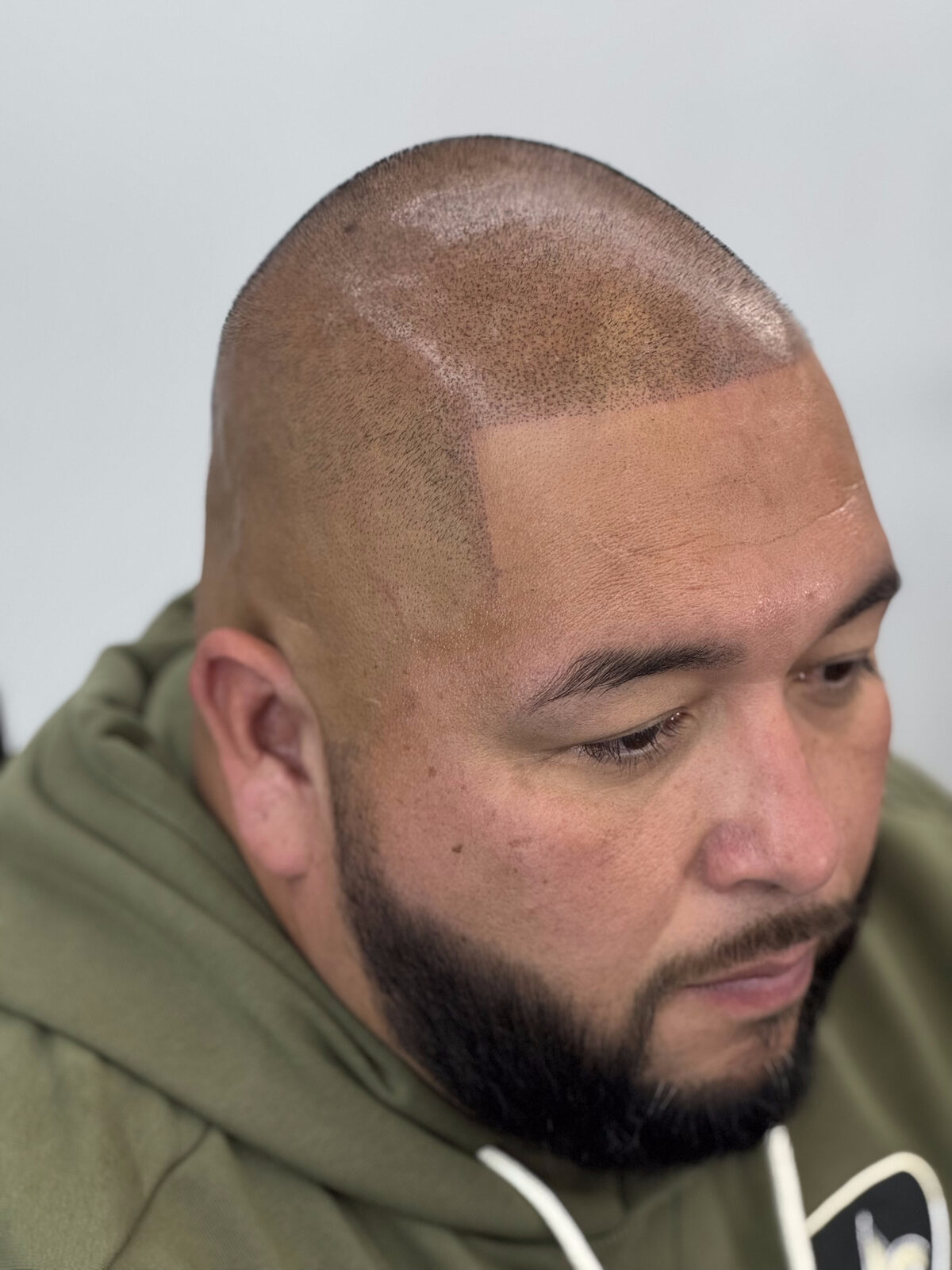 Finished scalp micropigmentation result