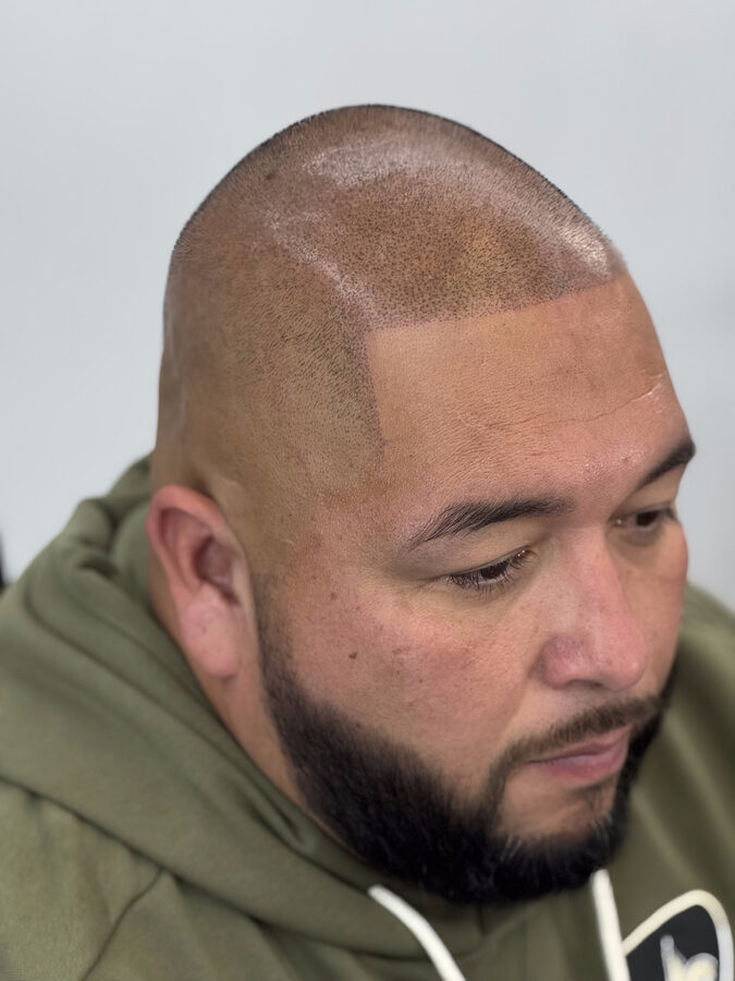 Scalp micropigmentation result — restored hairline and density