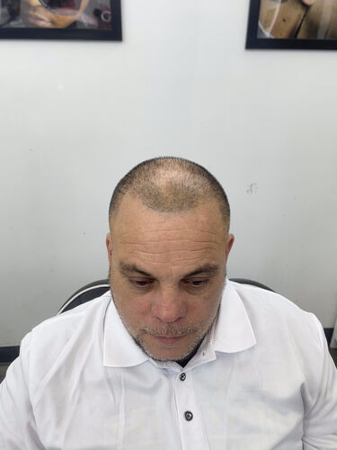 Scalp micropigmentation result by Shaun Fade — Metairie, LA