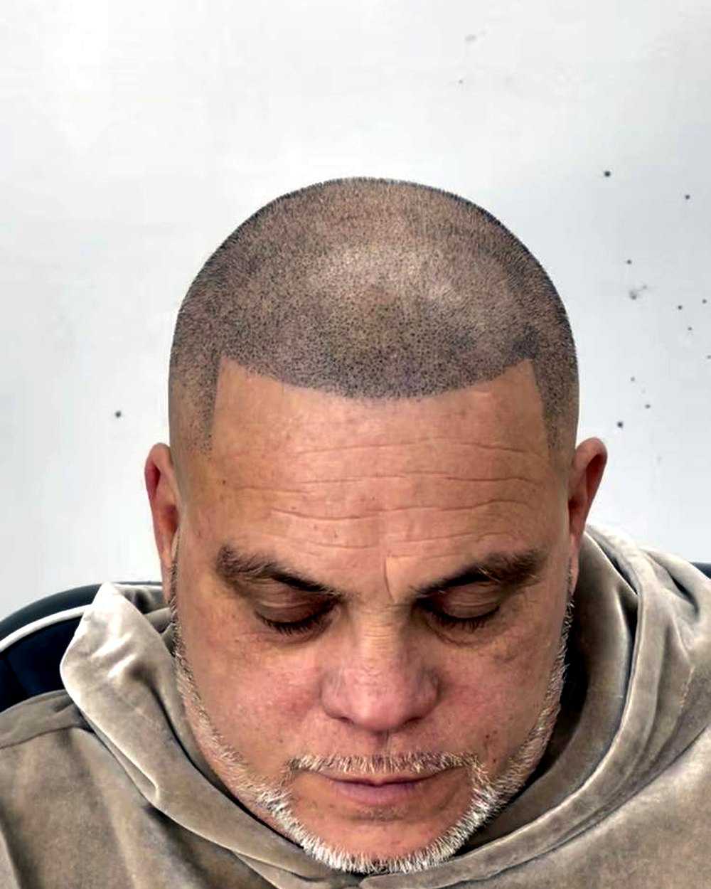 After scalp micropigmentation — restored density