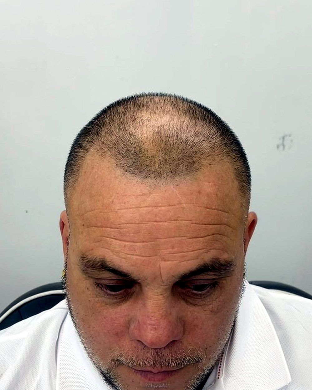 Before scalp micropigmentation — thinning crown